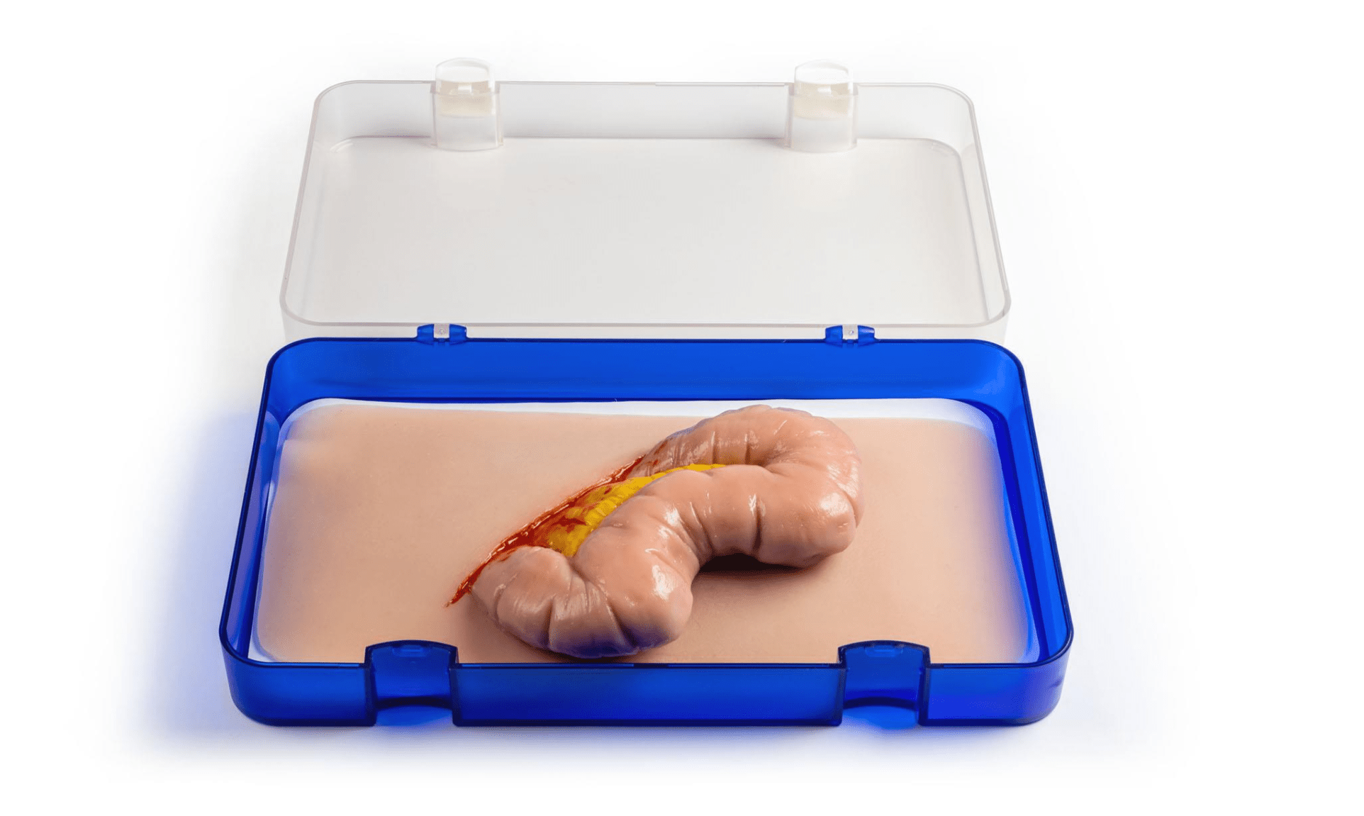 Wundmoulage Dickdarmaustritt - Erler - Zimmer